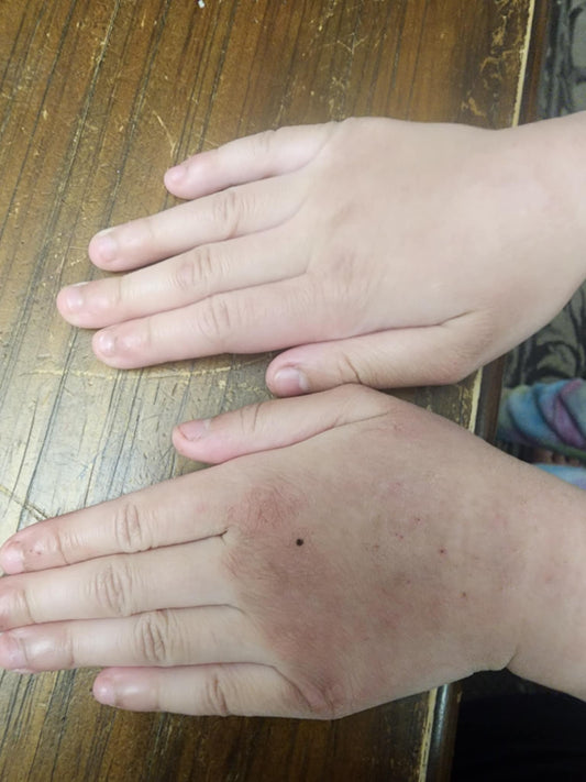 Both of my sons have eczema